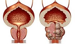 Healthy and unhealthy prostate