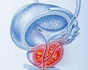 inflammation of the prostate with prostatitis